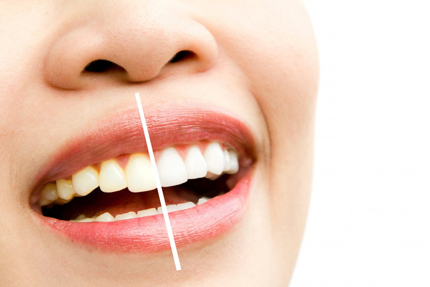 Clareamento dental rio grande do sul